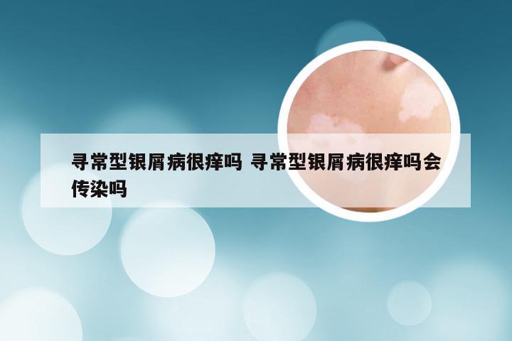 寻常型银屑病很痒吗 寻常型银屑病很痒吗会传染吗