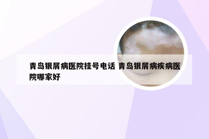 青岛银屑病医院挂号电话 青岛银屑病疾病医院哪家好