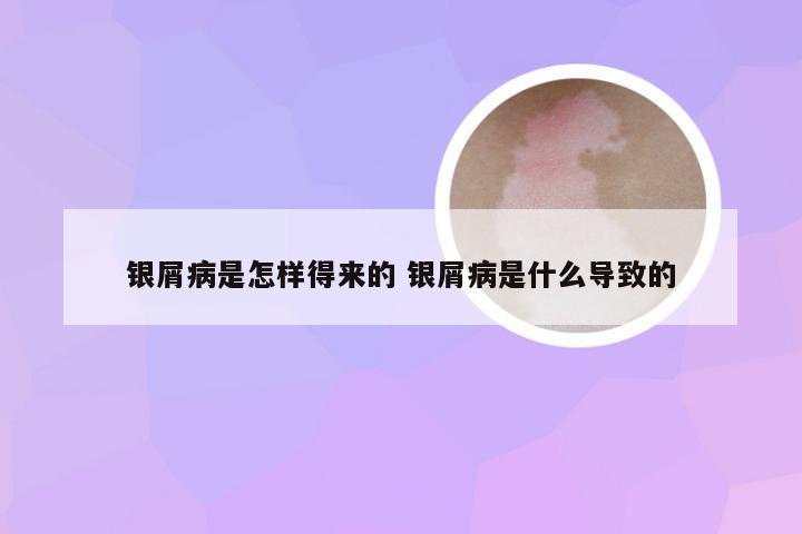 银屑病是怎样得来的 银屑病是什么导致的