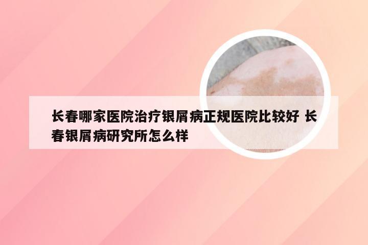 长春哪家医院治疗银屑病正规医院比较好 长春银屑病研究所怎么样