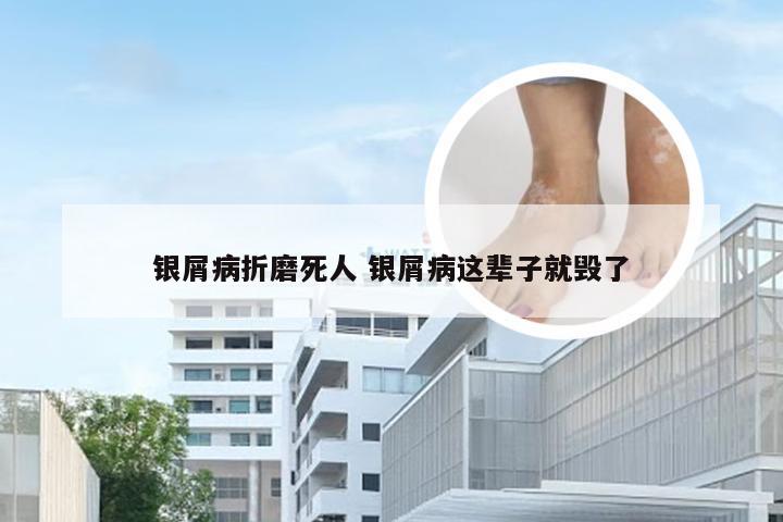 银屑病折磨死人 银屑病这辈子就毁了