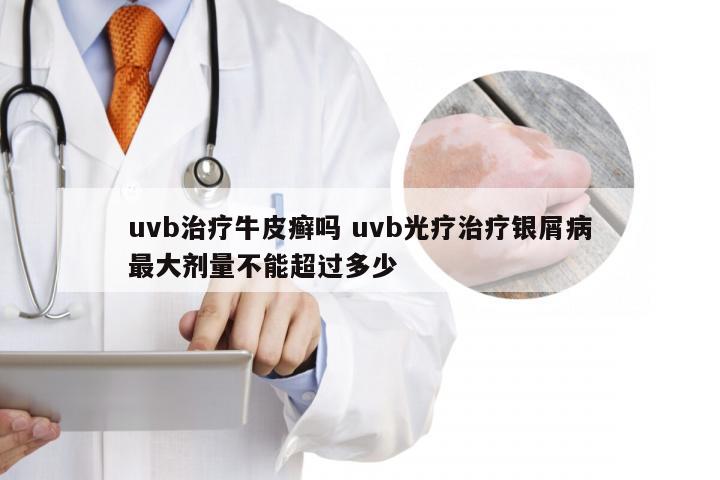 uvb治疗牛皮癣吗 uvb光疗治疗银屑病最大剂量不能超过多少