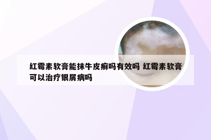 红霉素软膏能抹牛皮癣吗有效吗 红霉素软膏可以治疗银屑病吗