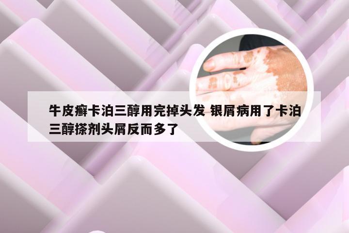 牛皮癣卡泊三醇用完掉头发 银屑病用了卡泊三醇搽剂头屑反而多了