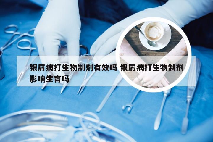 银屑病打生物制剂有效吗 银屑病打生物制剂影响生育吗