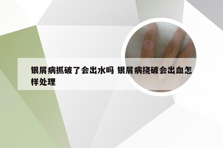 银屑病抓破了会出水吗 银屑病挠破会出血怎样处理