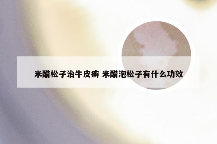 米醋松子治牛皮癣 米醋泡松子有什么功效