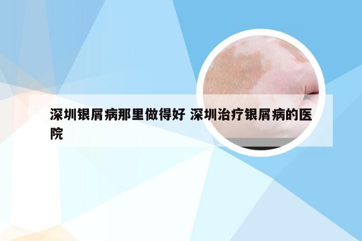 深圳银屑病那里做得好 深圳治疗银屑病的医院