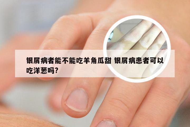 银屑病者能不能吃羊角瓜甜 银屑病患者可以吃洋葱吗?