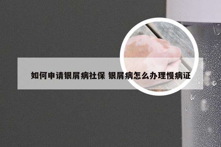 如何申请银屑病社保 银屑病怎么办理慢病证