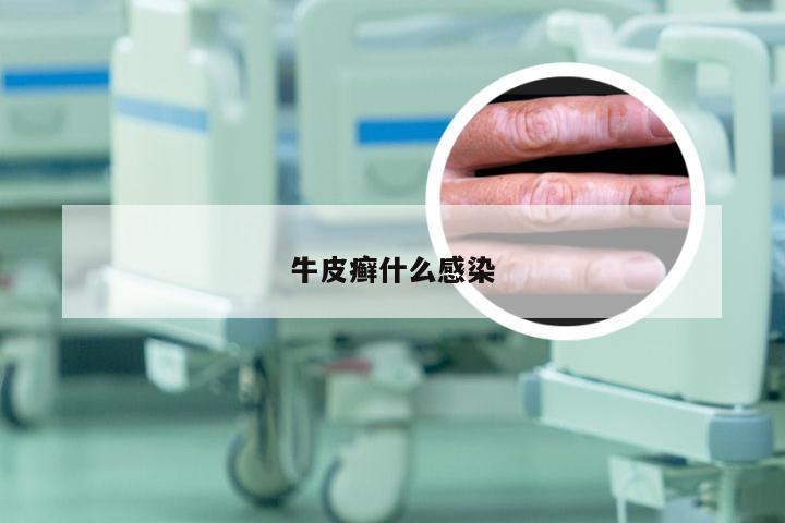 牛皮癣什么感染