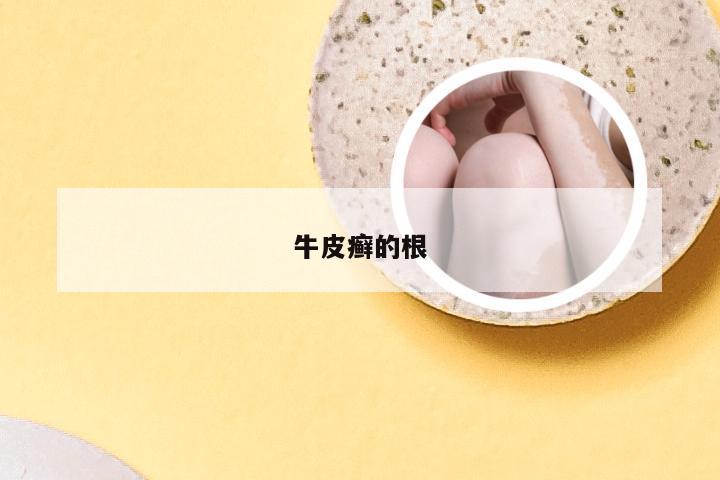 牛皮癣的根