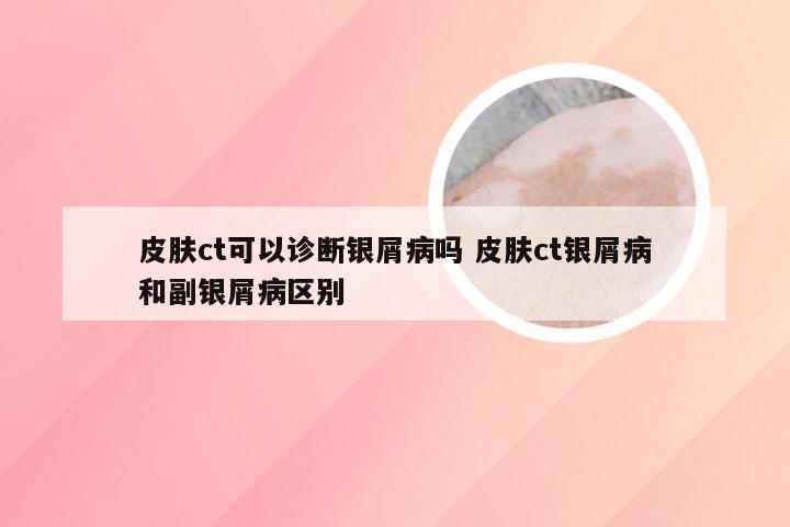 皮肤ct可以诊断银屑病吗 皮肤ct银屑病和副银屑病区别