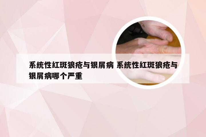 系统性红斑狼疮与银屑病 系统性红斑狼疮与银屑病哪个严重