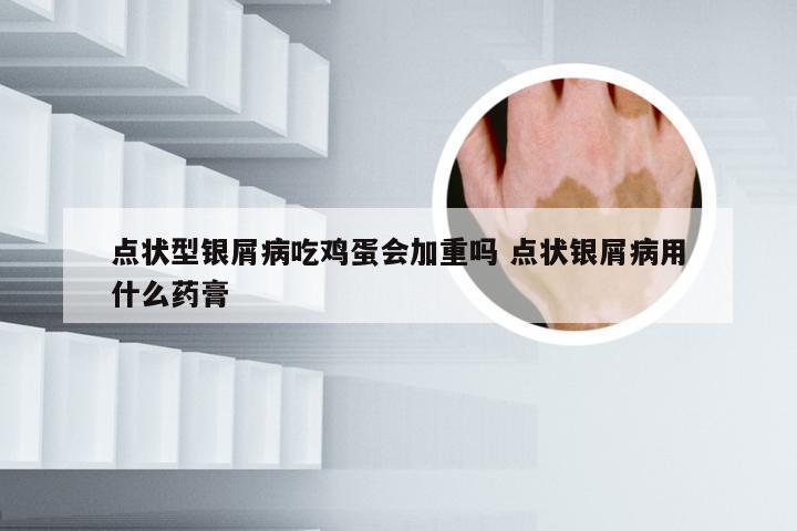 点状型银屑病吃鸡蛋会加重吗 点状银屑病用什么药膏