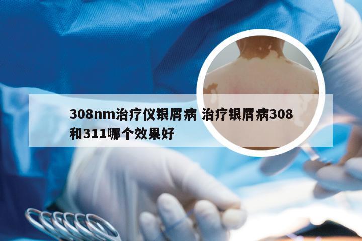 308nm治疗仪银屑病 治疗银屑病308和311哪个效果好