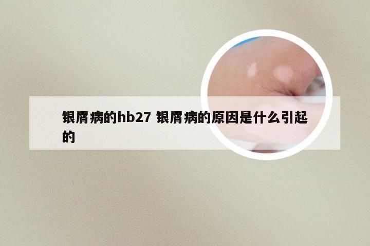 银屑病的hb27 银屑病的原因是什么引起的