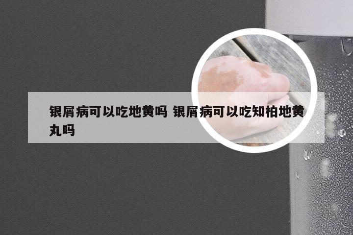 银屑病可以吃地黄吗 银屑病可以吃知柏地黄丸吗