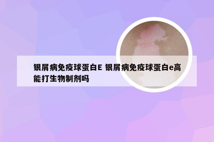 银屑病免疫球蛋白E 银屑病免疫球蛋白e高能打生物制剂吗