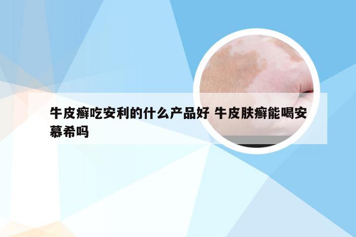 牛皮癣吃安利的什么产品好 牛皮肤癣能喝安慕希吗