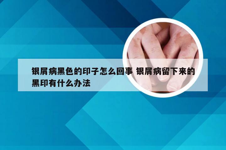 银屑病黑色的印子怎么回事 银屑病留下来的黑印有什么办法