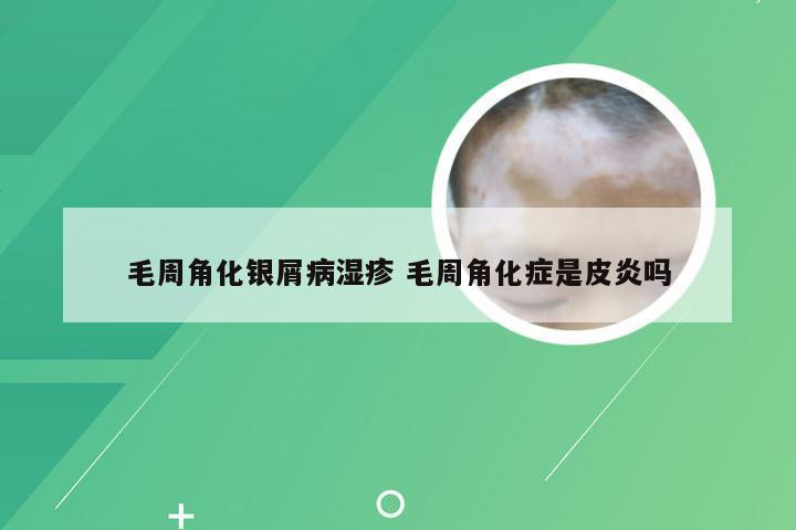 毛周角化银屑病湿疹 毛周角化症是皮炎吗