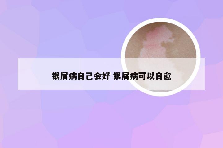 银屑病自己会好 银屑病可以自愈