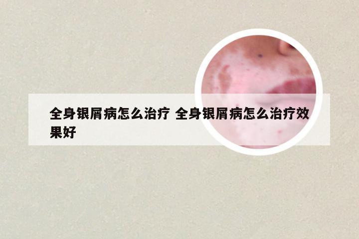 全身银屑病怎么治疗 全身银屑病怎么治疗效果好