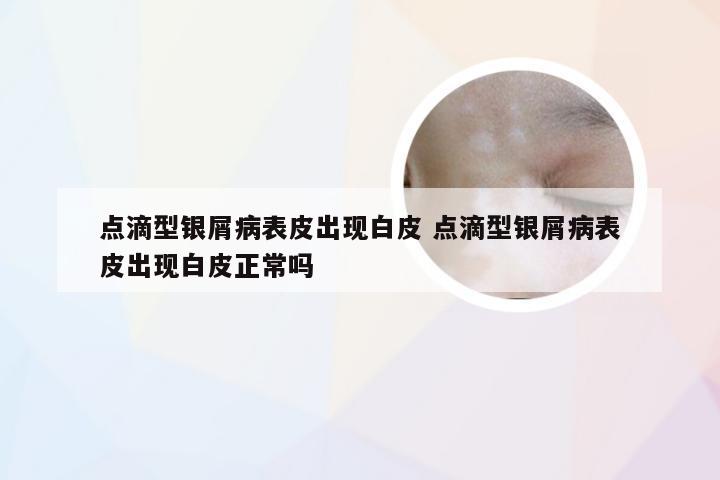 点滴型银屑病表皮出现白皮 点滴型银屑病表皮出现白皮正常吗