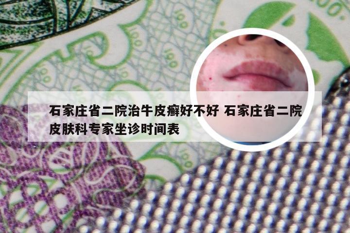 石家庄省二院治牛皮癣好不好 石家庄省二院皮肤科专家坐诊时间表