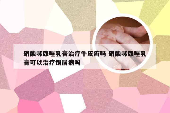 硝酸咪康唑乳膏治疗牛皮癣吗 硝酸咪康唑乳膏可以治疗银屑病吗