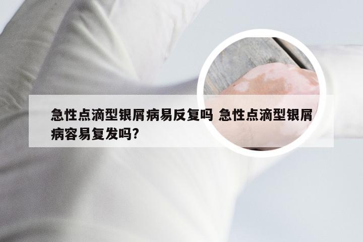 急性点滴型银屑病易反复吗 急性点滴型银屑病容易复发吗?