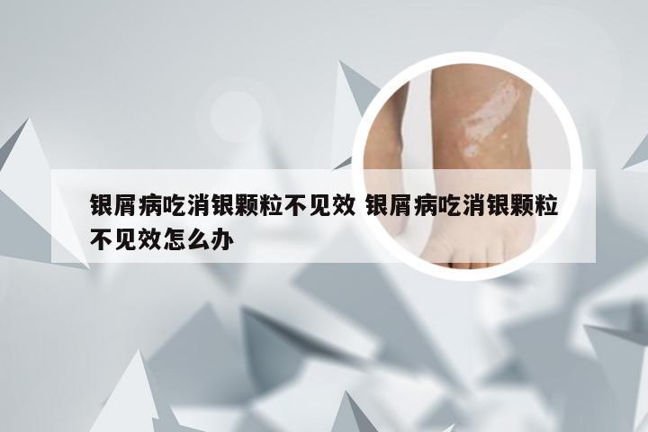 银屑病吃消银颗粒不见效 银屑病吃消银颗粒不见效怎么办