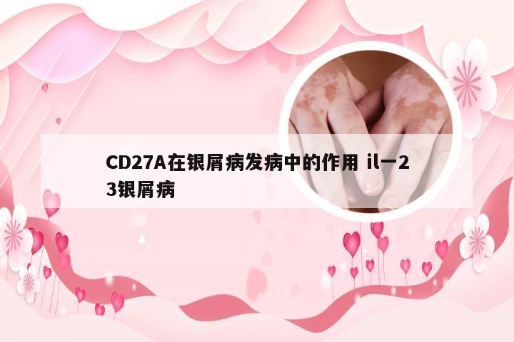 CD27A在银屑病发病中的作用 il一23银屑病