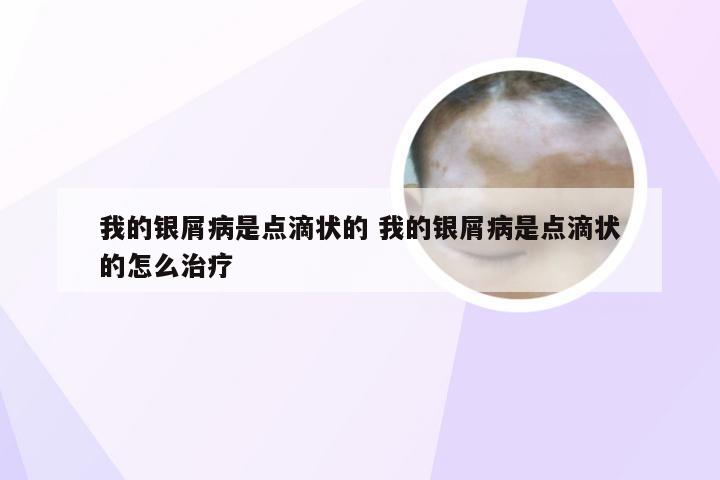 我的银屑病是点滴状的 我的银屑病是点滴状的怎么治疗