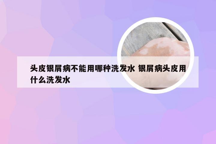 头皮银屑病不能用哪种洗发水 银屑病头皮用什么洗发水