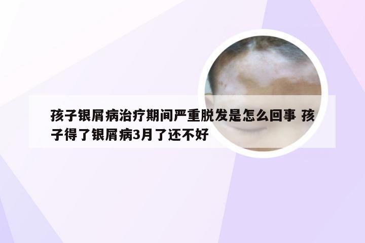 孩子银屑病治疗期间严重脱发是怎么回事 孩子得了银屑病3月了还不好