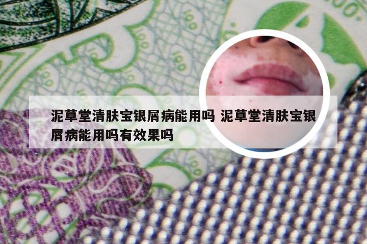 泥草堂清肤宝银屑病能用吗 泥草堂清肤宝银屑病能用吗有效果吗