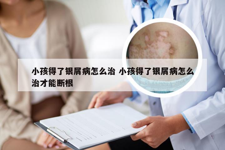 小孩得了银屑病怎么治 小孩得了银屑病怎么治才能断根