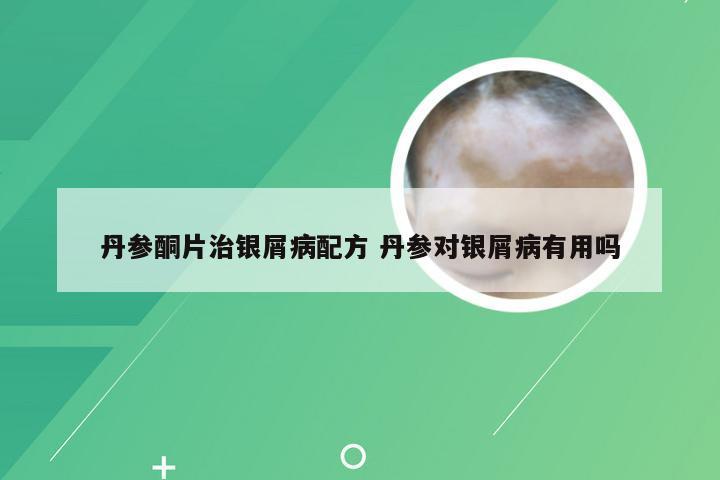 丹参酮片治银屑病配方 丹参对银屑病有用吗