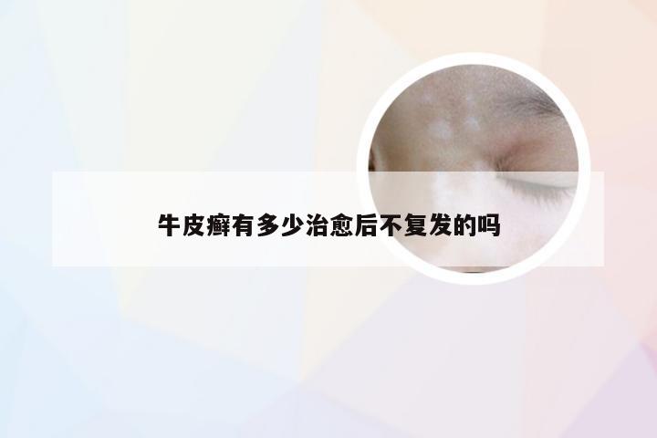 牛皮癣有多少治愈后不复发的吗