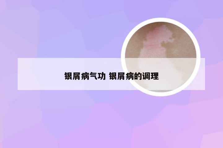 银屑病气功 银屑病的调理