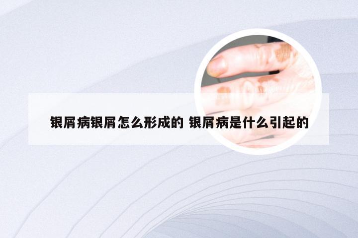 银屑病银屑怎么形成的 银屑病是什么引起的