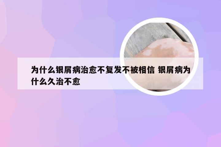 为什么银屑病治愈不复发不被相信 银屑病为什么久治不愈