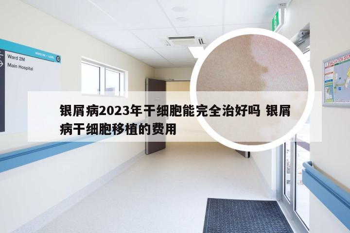 银屑病2023年干细胞能完全治好吗 银屑病干细胞移植的费用