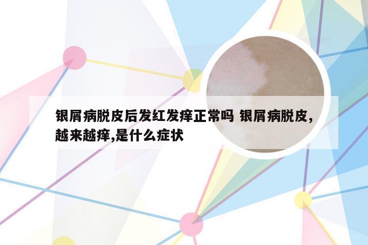 银屑病脱皮后发红发痒正常吗 银屑病脱皮,越来越痒,是什么症状