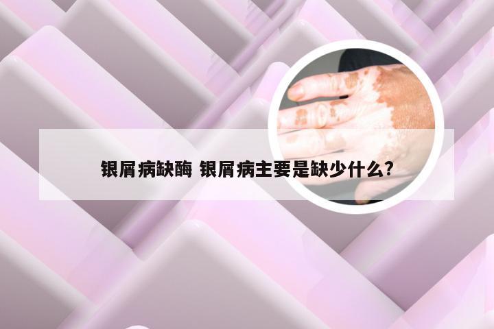 银屑病缺酶 银屑病主要是缺少什么?