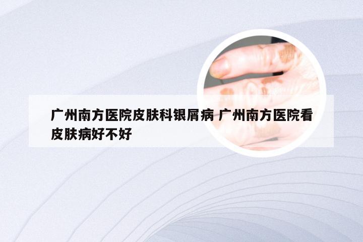 广州南方医院皮肤科银屑病 广州南方医院看皮肤病好不好