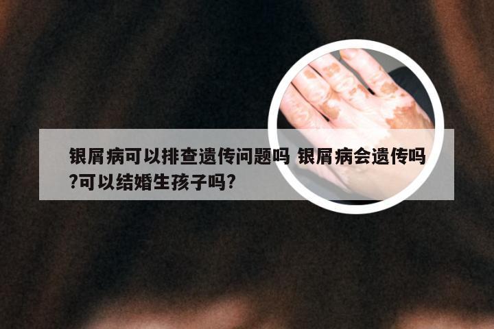 银屑病可以排查遗传问题吗 银屑病会遗传吗?可以结婚生孩子吗?