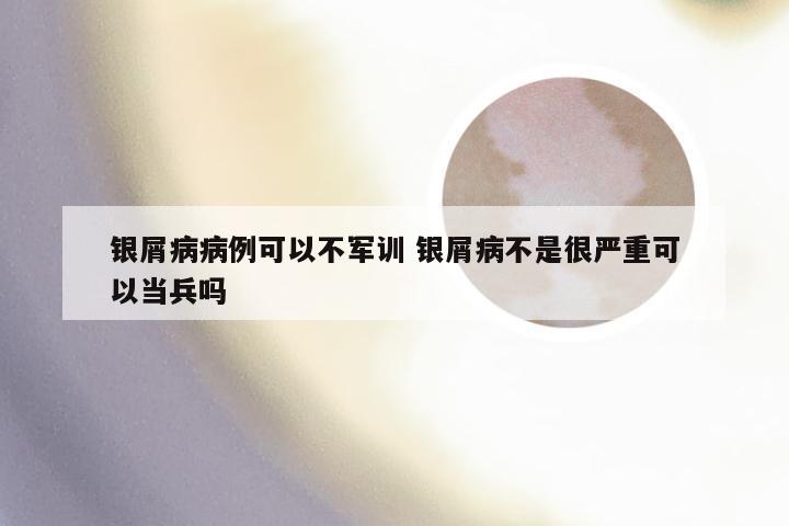 银屑病病例可以不军训 银屑病不是很严重可以当兵吗